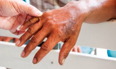 Preocupan casos de lepra en Tlaltizapán