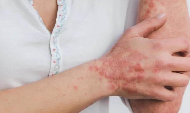 Brote de lepra en Tlaltizapán  genera alerta a nivel nacional