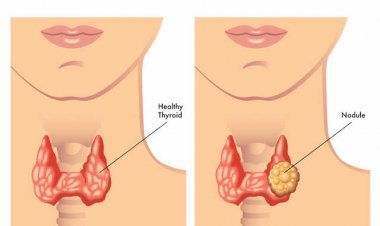 Se exhorta a evitar males de  tiroides con peso correcto