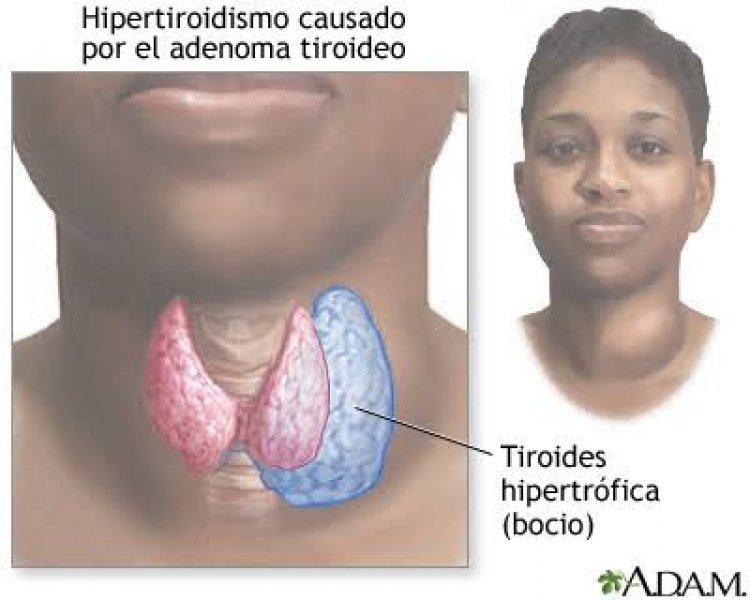 Se exhorta a evitar males de  tiroides con peso correcto