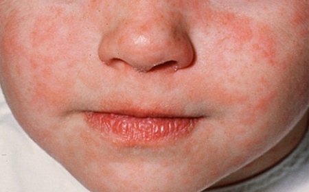 Con el caso más reciente importado de  Michoacán, 17 enfermos de sarampión