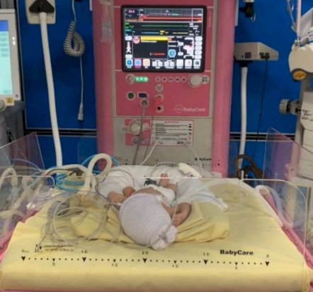Nacen trillizas en el Hospital  de la Mujer en Yautepec